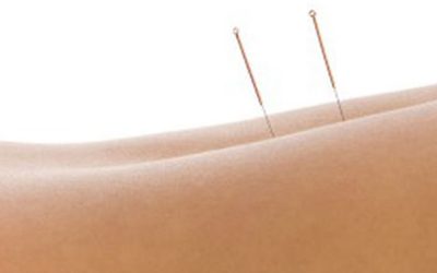 Is Dry Needling a Treatment For You?