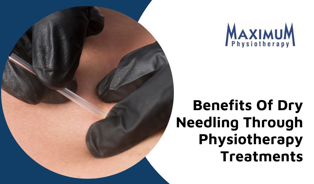 7 Health Benefits Of Dry Needling Through Physiotherapy Treatments
