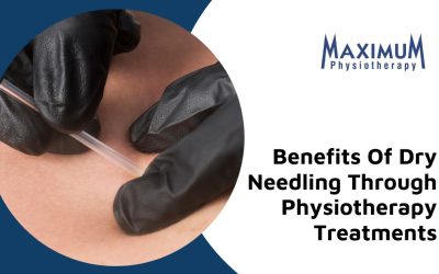 7 Health Benefits Of Dry Needling Through Physiotherapy Treatments