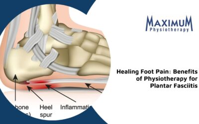 Healing Foot Pain: Benefits of Physiotherapy for Plantar Fasciitis