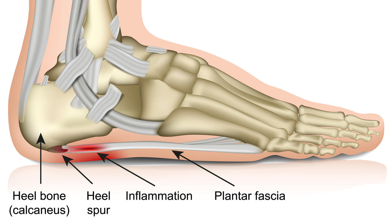 physiotherapy for plantar fasciitis