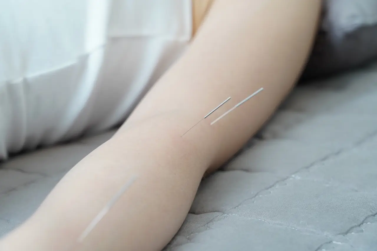 acupuncture collingwood