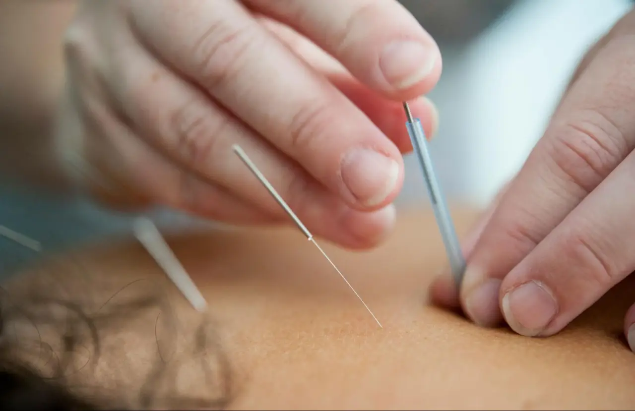 best acupuncture collingwood